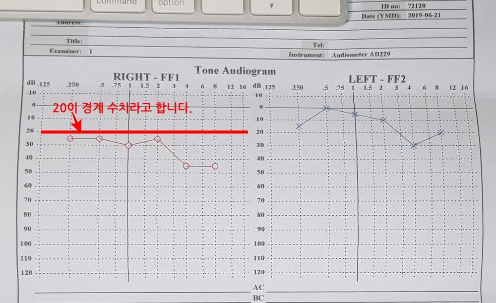 귀울림/이명과 돌발성난청 발생, 그리고 치료